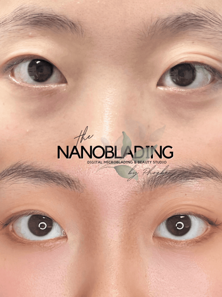 Healed Asian Nose Bridge Contoruing (1)